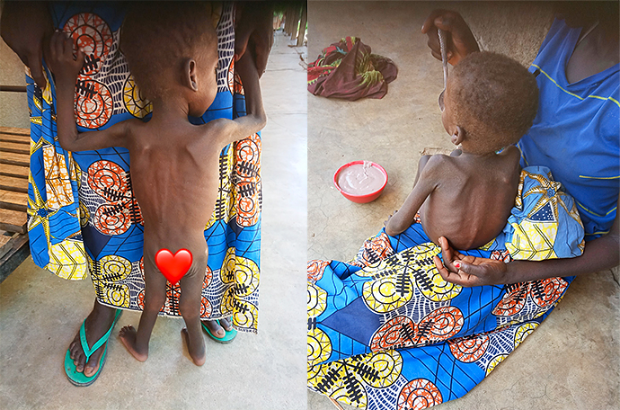 unterernährtes Kind Afrika Kamerun Nord