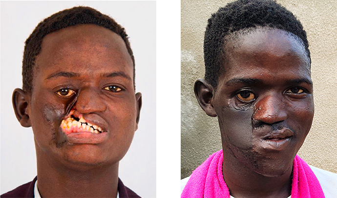 Daniel Noma Gesichtsdeformation Kamerun Krankheit