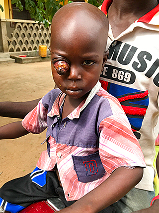 Retinoblastom Augenkrebs Kind Kamerun