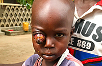Autenkrebs Retinoblastom Kind Krankheit Kamerun