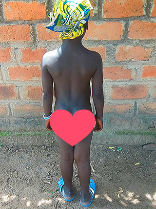 Steissbein Tumor Kind Kamerun