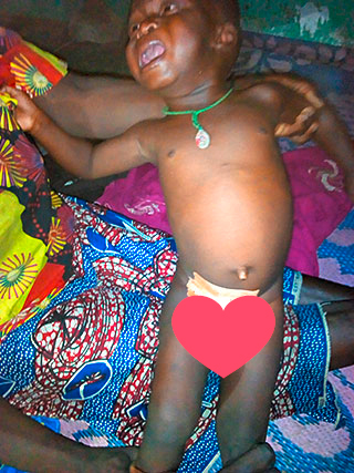 Hodenbruch Kind Kamerun