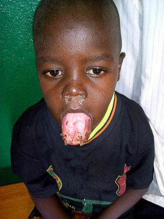 Lymphangiom Krankheit Kind Kamerun
