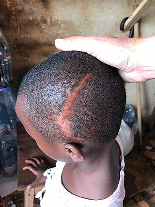 Schädel-Hirn-Trauma Kind Kamerun