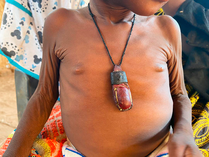 Hunger Afrika Hungersnot Krankheit Amulett Kamerun Nordkamerun Kousseri Logone-Birni