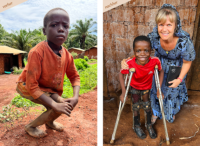 Kinderoperationen Afrika Kamerun Rachitis Spitalbehandlung