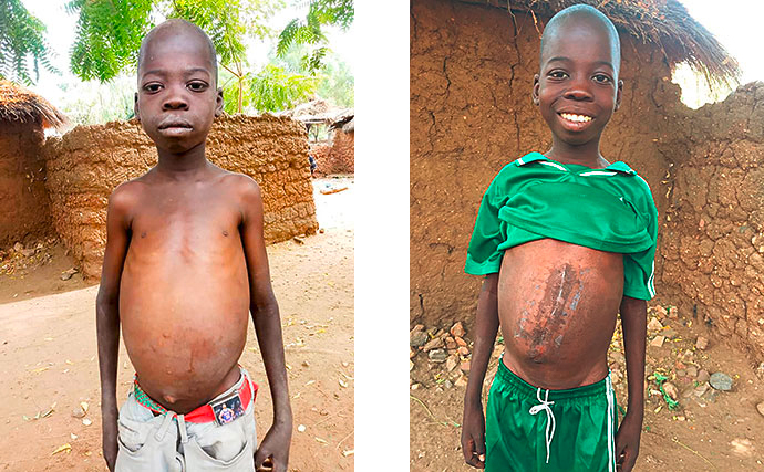 Simke Milzvergrösserung Operation Kind Kamerun