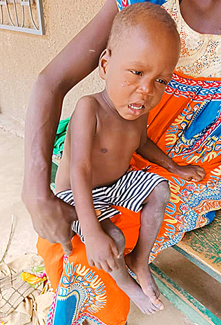 Kinderoperationen Ashia Kamerun