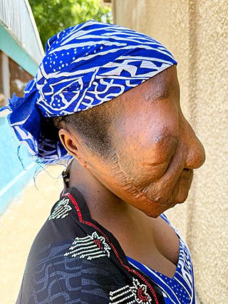 Gesichtstumor Kamerun Kinderoperation