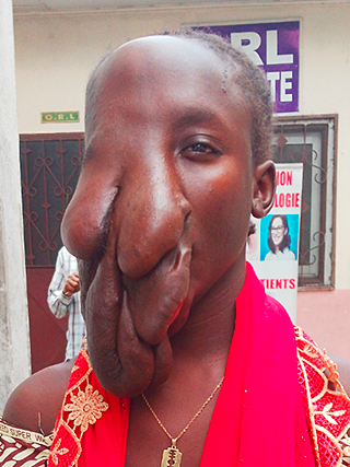 Gesichtstumor Kamerun Kinderoperation