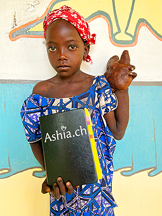 Handtumor Kinderoperation Kamerun Kinderhilfswerk