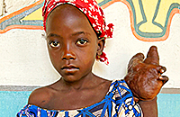 Handtumor Kinderoperation Kamerun Kinderhilfswerk