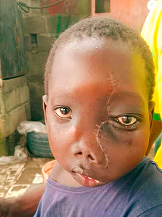 Gesichtstumor Kinderoperation Kamerun