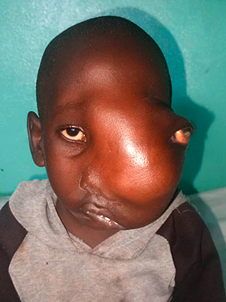 Gesichtstumor Kinderoperation Kamerun