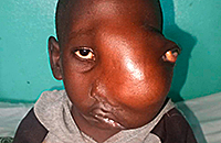 Gesichtstumor Kinderoperation Kamerun Kinderhilfswerk