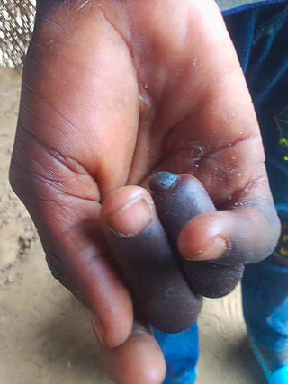 Handoperation Fingeroperation Hand-Deformation