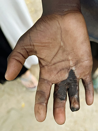 Handoperation Fingeroperation Hand-Deformation