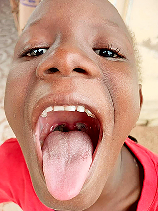 Tonsillitis Mandeloperation Kinderspital Kinderoperation