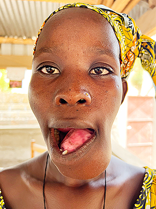 Neurofibromatose Kinderoperation Spitalbehandlung Kamerun
