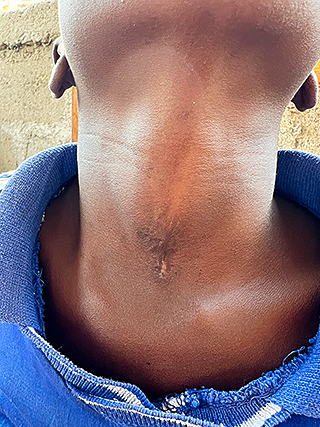 Halsfistel Kinderoperation Kamerun Kinderhilfswerk