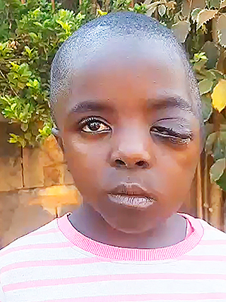 Neurofibromatose Kamerun Kinderoperation