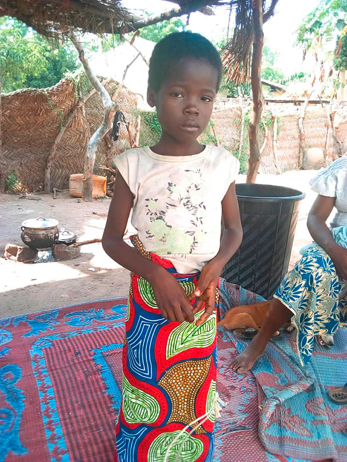 Spina Bifida Aperta Krankheit Kind Kamerun