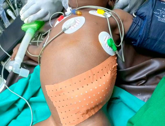 Anorektale Fehlbildung Kamerun Kinderoperation