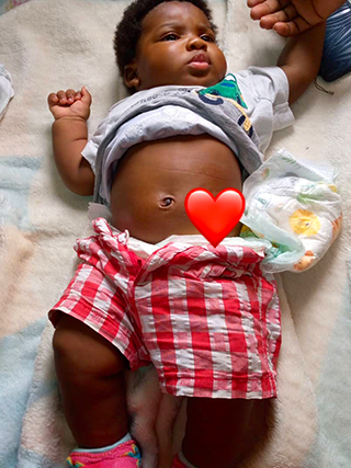 Anorektale Fehlbildung Kamerun Kinderoperation