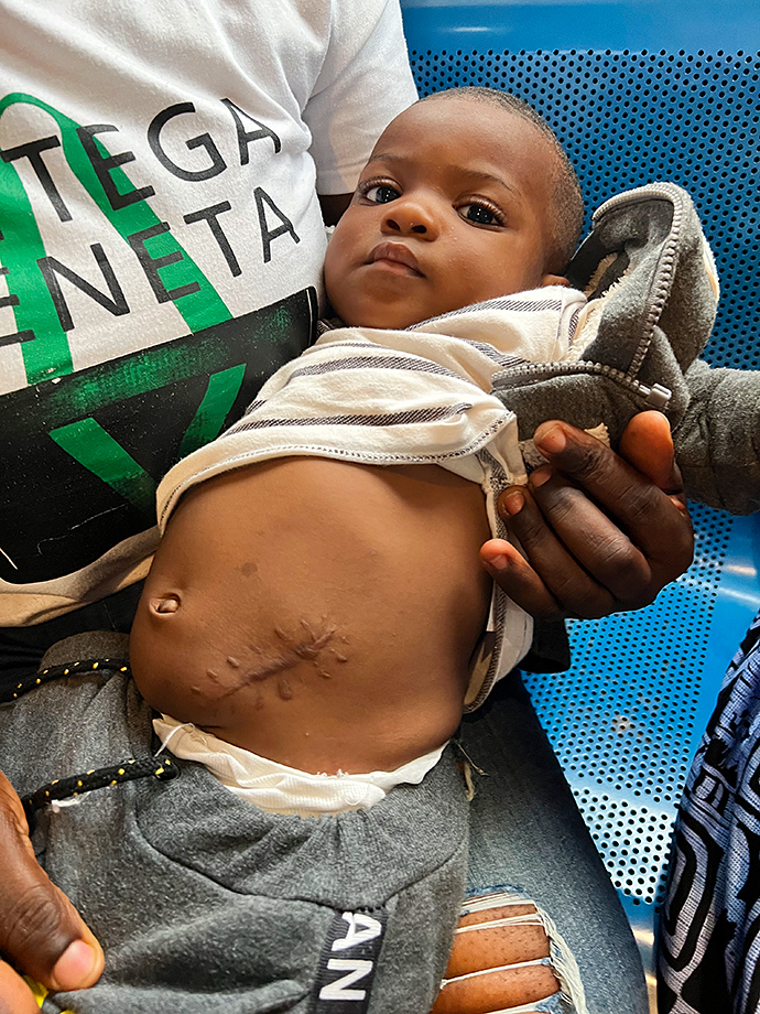 Anorektale Fehlbildung Kamerun Kinderoperation